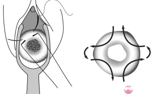 罗列最新的广州三代试管包成功的过程！