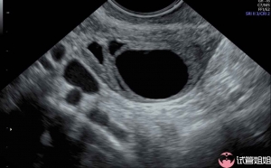 同性恋在北京医院做三代试管婴儿的费用标准是怎么样？