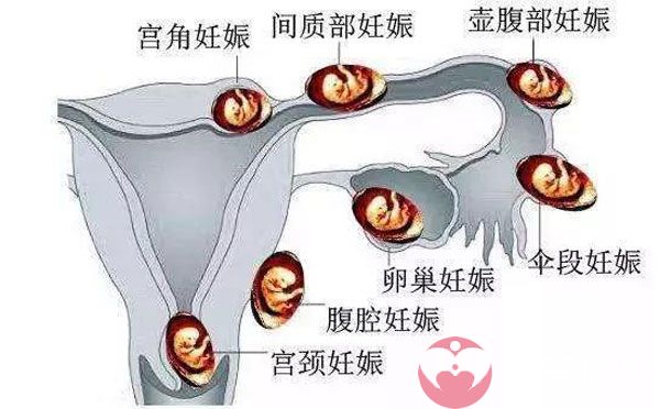 输卵管问题容易导致宫外孕