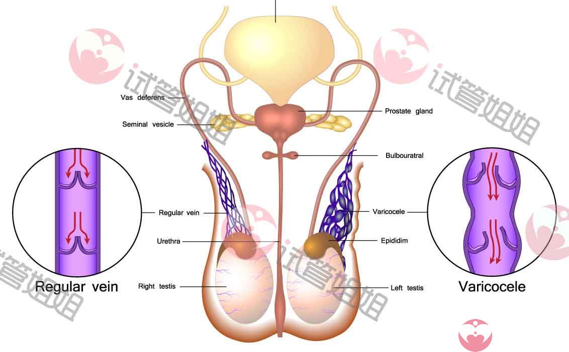 精索静脉曲张可能导致男性不育