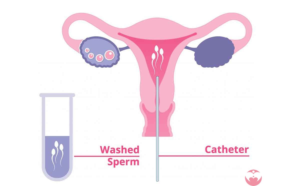 输卵管必须通畅才可进行人工授精