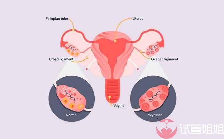 多囊卵巢综合征可以做美国试管婴儿吗