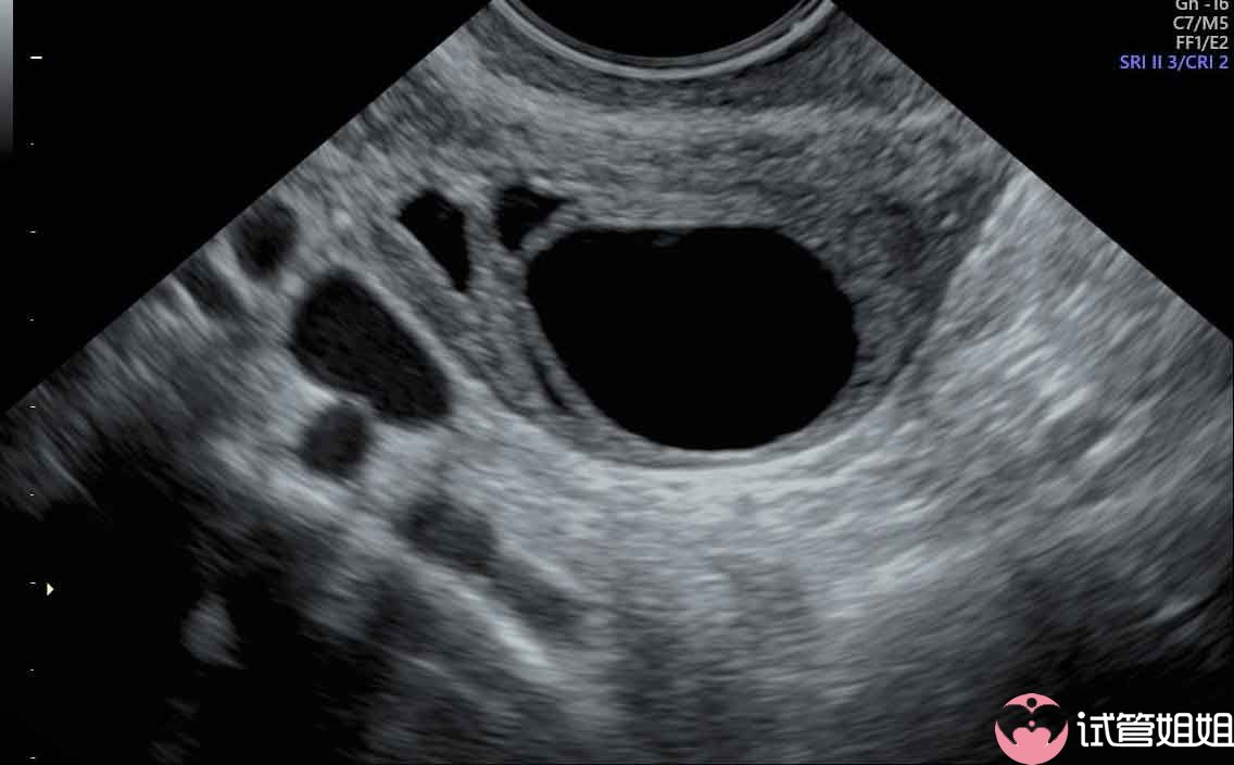 2024年女性做完三代试管婴儿促排后对身体有伤害吗